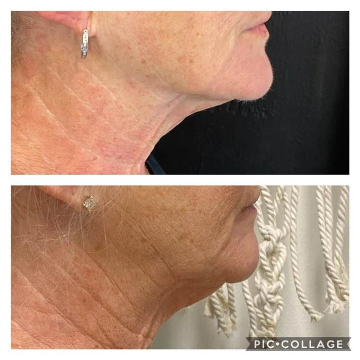 Cryotherapy Slimming Machine