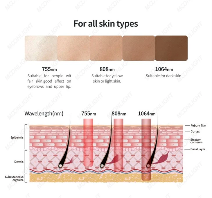 Soprano Titanium Treatment Procedure